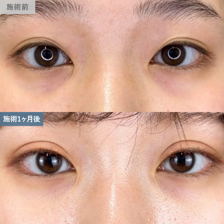 寺西 宏王医師の二重整形の症例写真17
