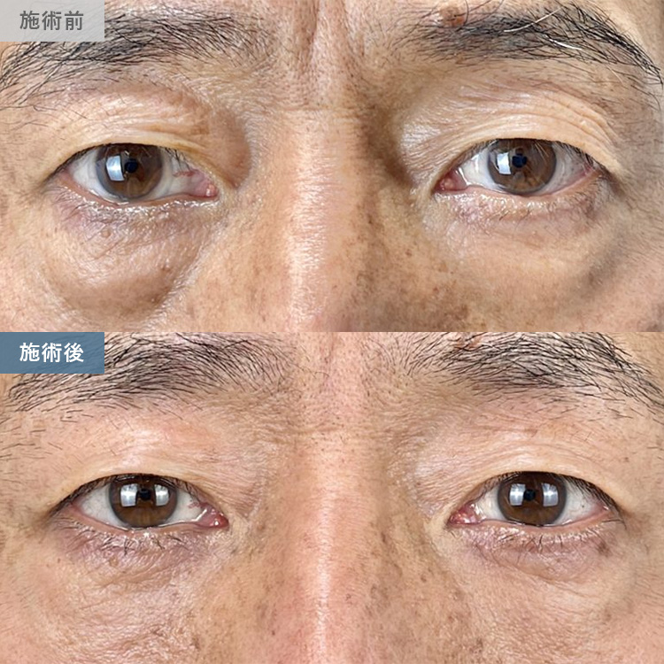 クマ取りの症例写真02