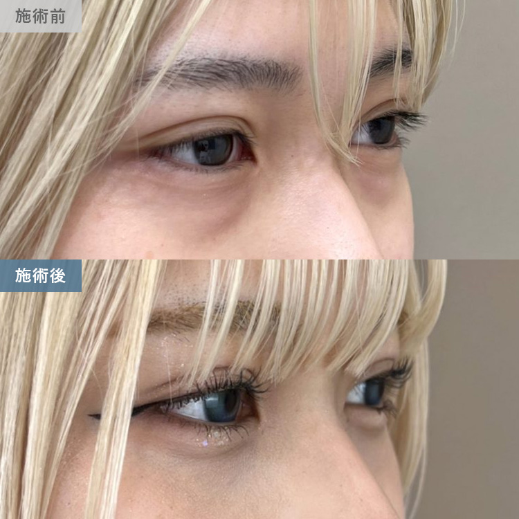 クマ取りの症例写真06