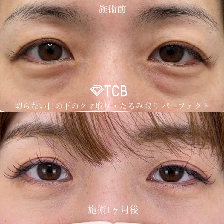 クマ取りの症例写真10