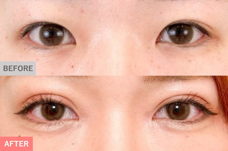 幅広平行型二重 切開法