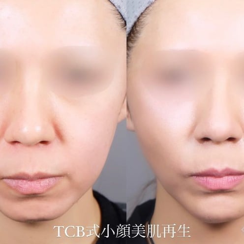 TCB式小顔美肌再生 症例写真