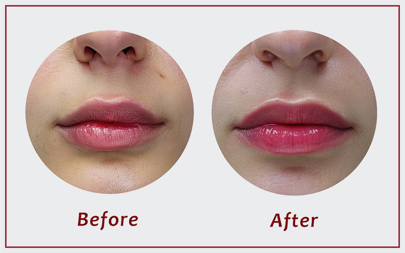 リップグロス注射のビフォーアフター