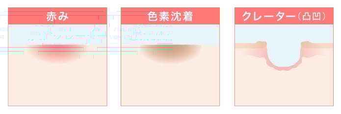 ニキビ跡の種類