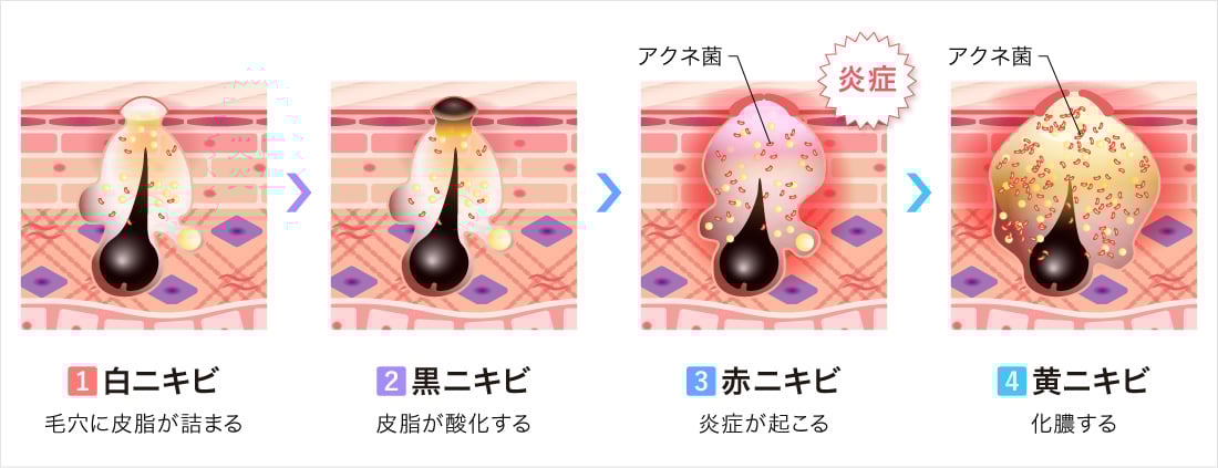ニキビ治療・ニキビ跡治療 | 美容整形はTCB東京中央美容外科