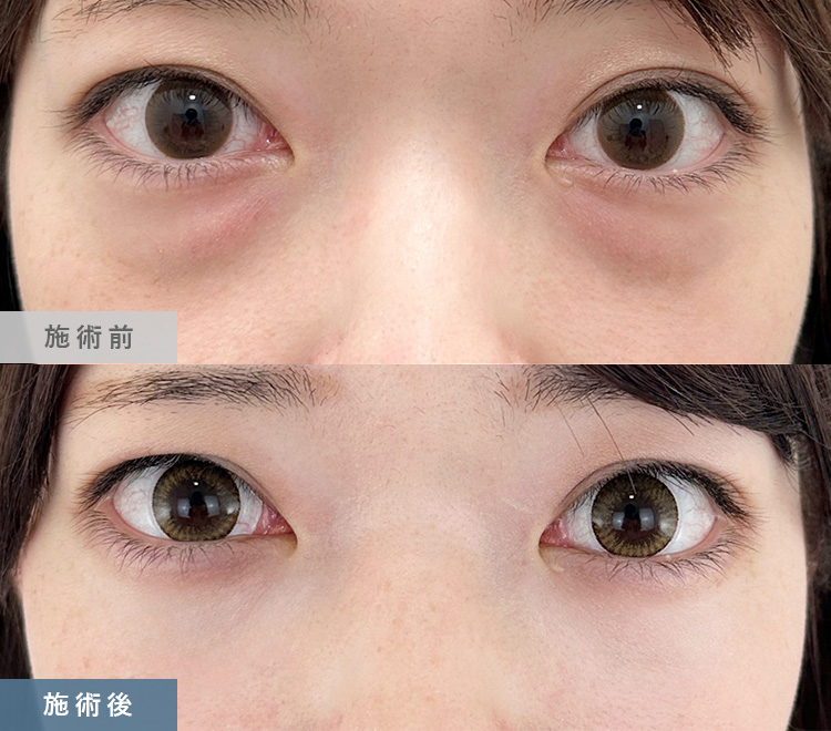 皮膚を切らない目の下のクマ取り・たるみ（ふくらみ）取り | 美容整形
