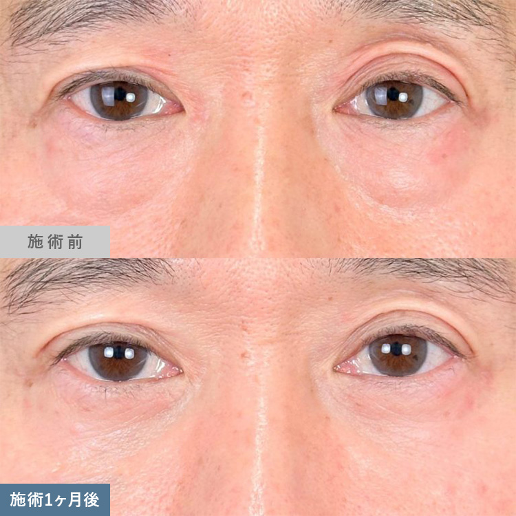 皮膚を切らない目の下のクマ取り・たるみ（ふくらみ）取り | 美容整形