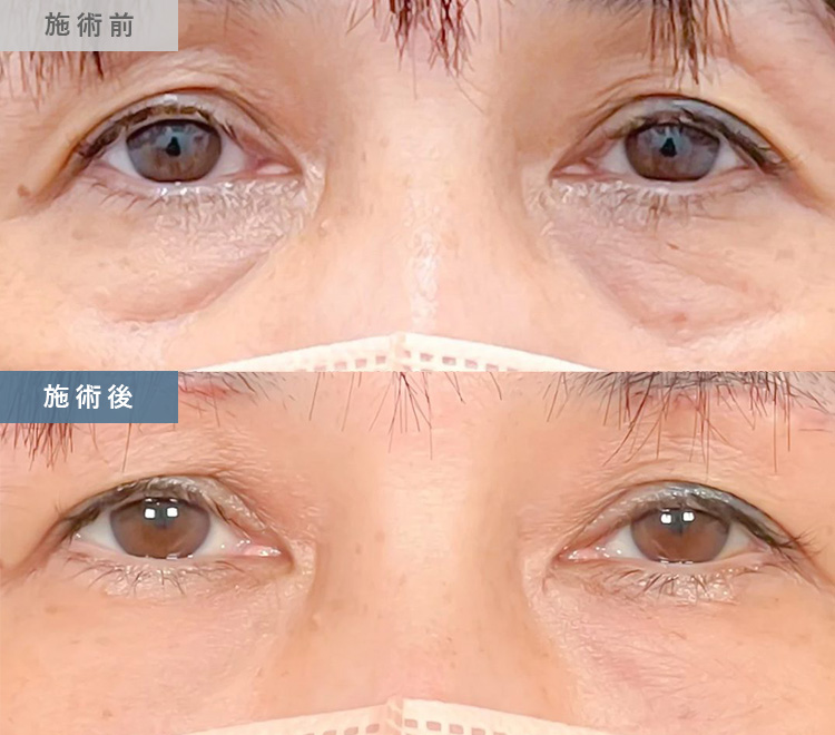 皮膚を切らない目の下のクマ取り・たるみ（ふくらみ）取り | 美容整形