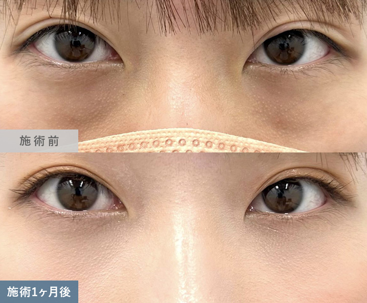 皮膚を切らない目の下のクマ取り・たるみ（ふくらみ）取り | 美容整形