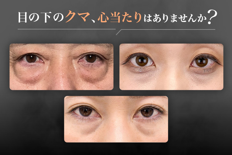 皮膚を切らない目の下のクマ取り・たるみ（ふくらみ）取り | 美容整形