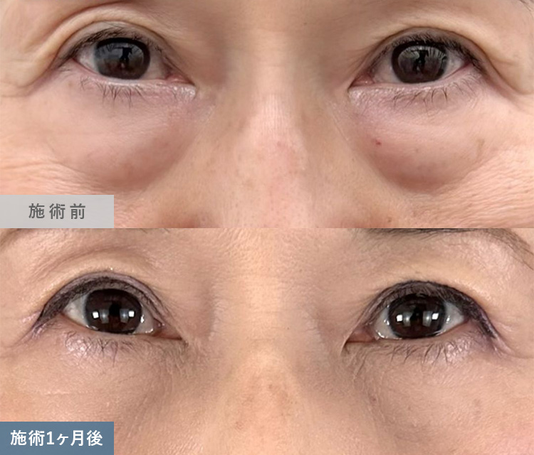 皮膚を切らない目の下のクマ取り・たるみ（ふくらみ）取りとシワ取り再生注射（スネコス注射）を併用した症例写真