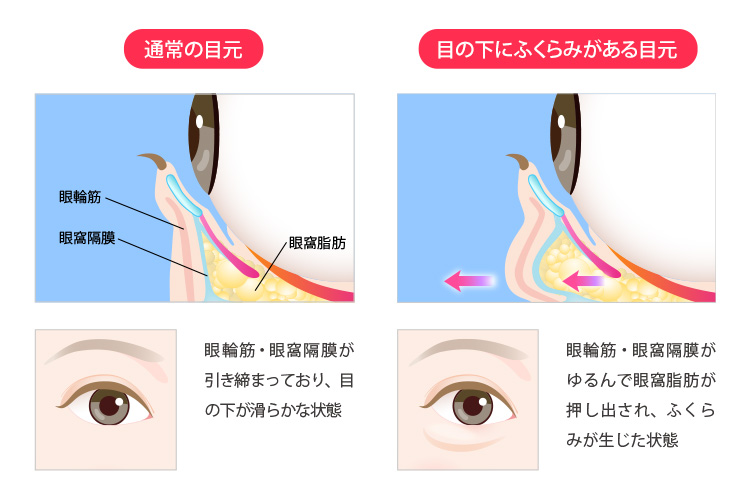 皮膚を切らない目の下のクマ取り・たるみ（ふくらみ）取り | 美容整形