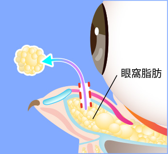 目の下の脂肪取り（経結膜脱脂法）の施術方法02