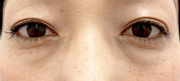 目の下の脂肪が浮き出た影、老化現象により目の下の皮膚がたるんでしまうのが原因。