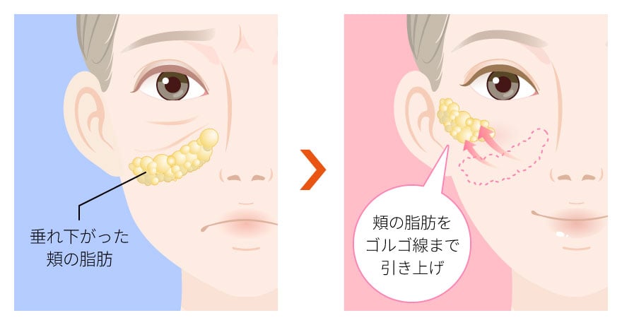 ミッドフェイスリフトの仕組み