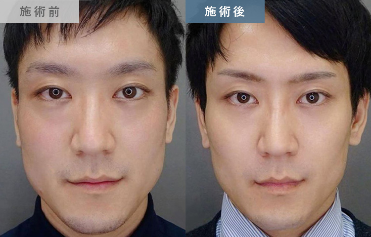 エラのボトックス小顔注射の症例写真03
