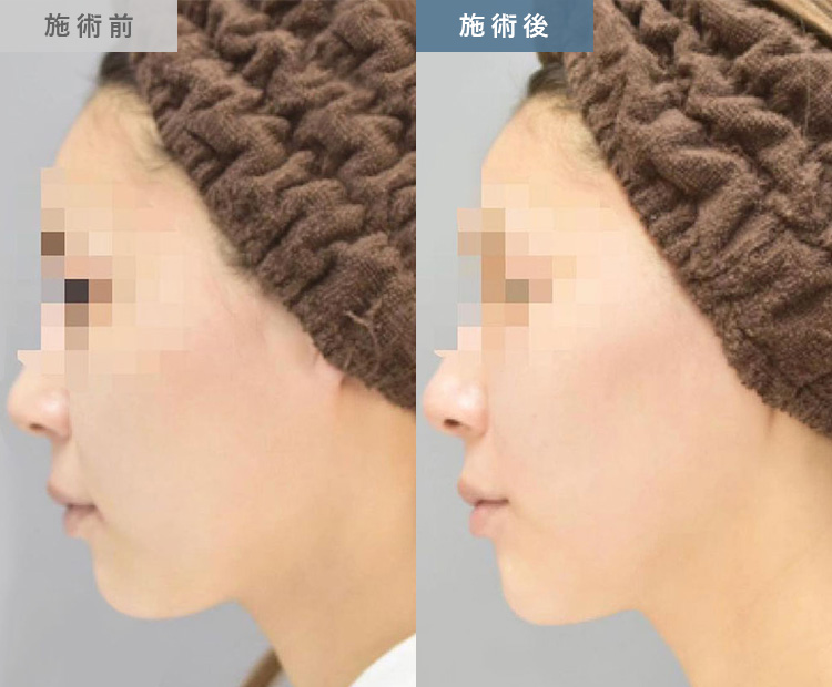 エラのボトックス小顔注射の症例写真04