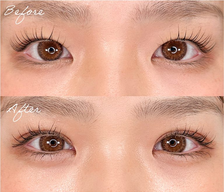 MIX二重の症例写真