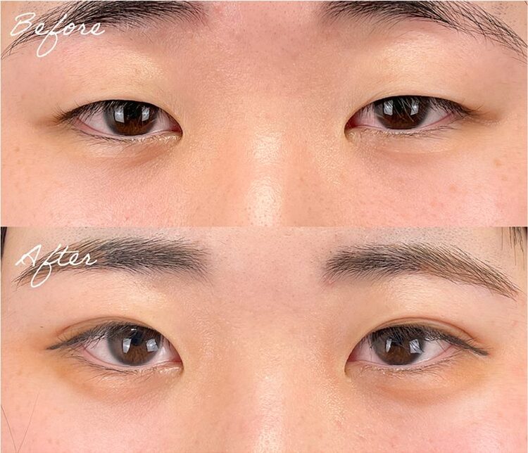 二重埋没法+まぶたの脂肪取りの症例写真