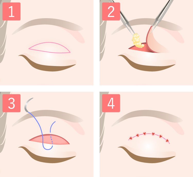 二重全切開法の手術方法