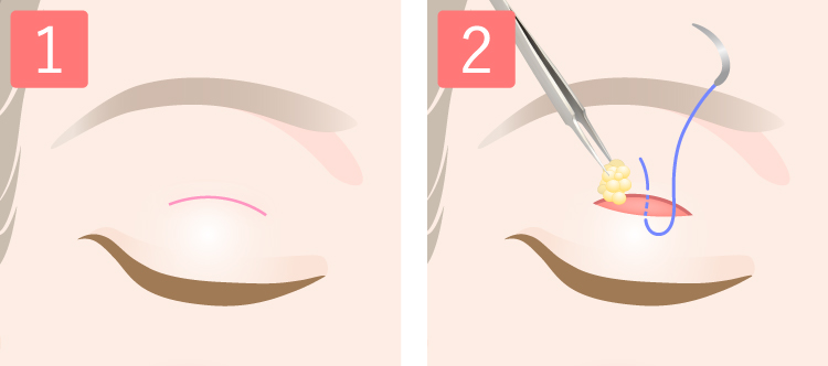 二重部分切開法の手術方法