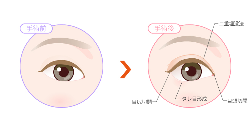 タレ目形成＋二重埋没法＋目尻切開＋目頭切開のイラスト