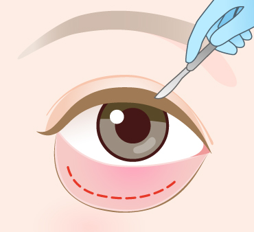 グラマラスライン形成（結膜切開法）の手術方法01