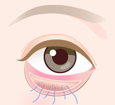グラマラスライン形成（結膜切開法）の手術方法02