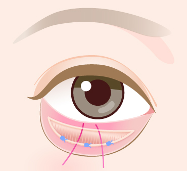 グラマラスライン形成（結膜切開法）の手術方法03