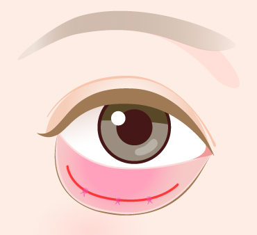 グラマラスライン形成（結膜切開法）の手術方法04