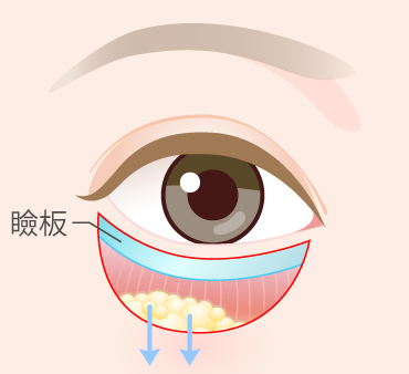 グラマラスライン形成（皮膚切開法）の手術方法02