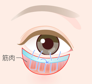 グラマラスライン形成（皮膚切開法）の手術方法03