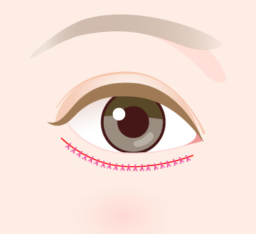 グラマラスライン形成（皮膚切開法）の手術方法04