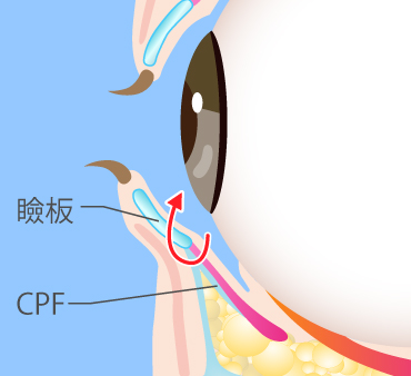 グラマラスライン形成（埋没法）の施術方法02