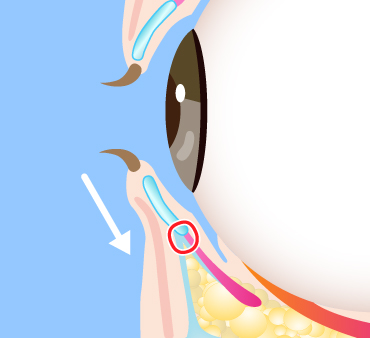 グラマラスライン形成（埋没法）の施術方法03