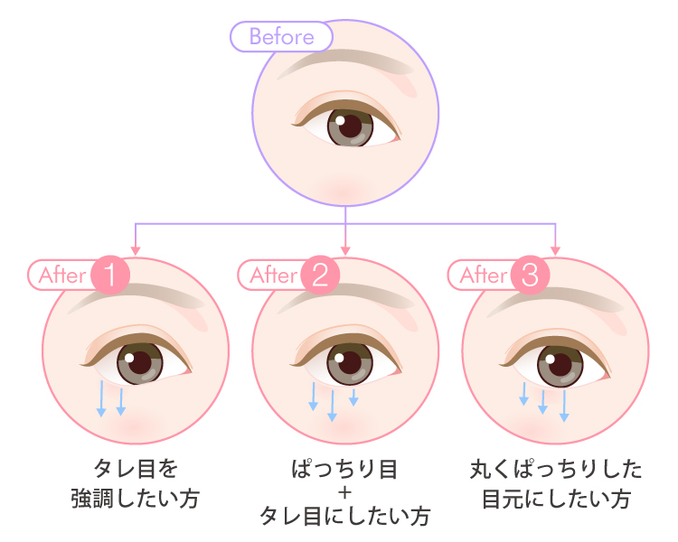 グラマラスライン形成の3種類のデザイン