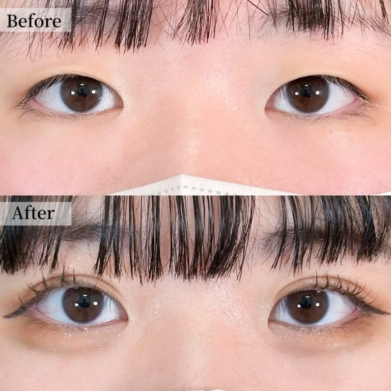 二重埋没法の症例写真01