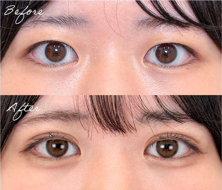 二重埋没法の症例写真02