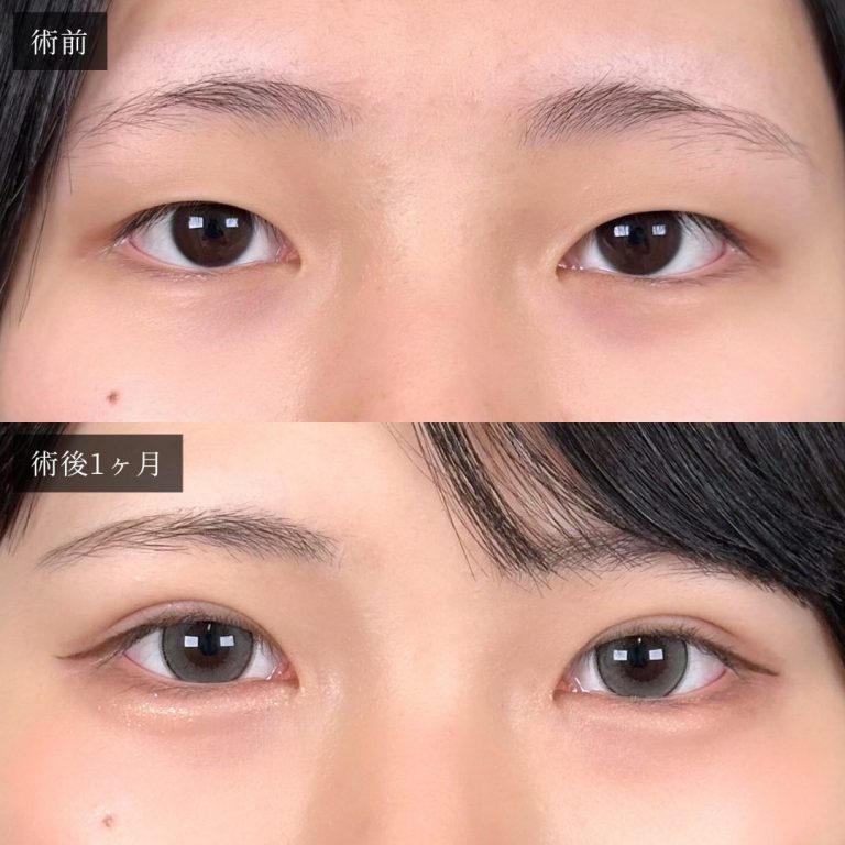 二重埋没法の症例写真03