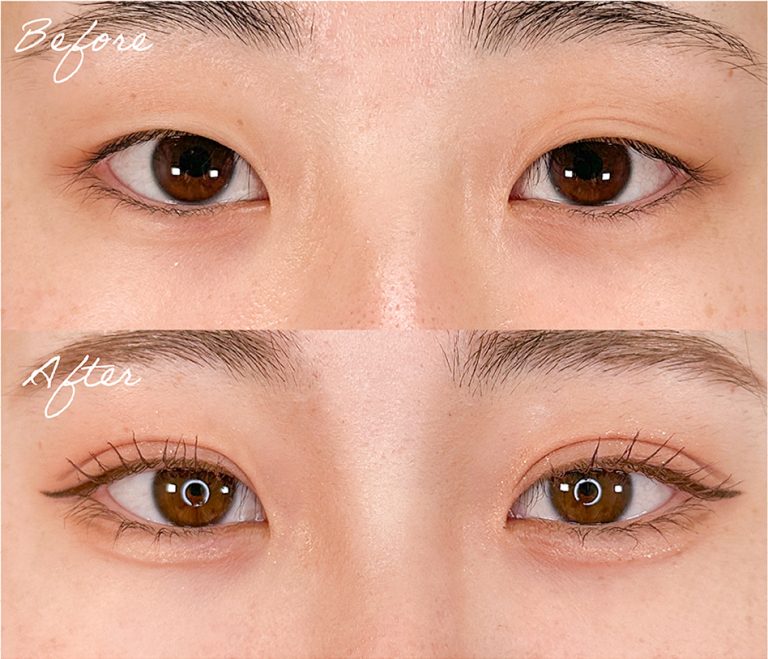 二重埋没法の症例写真04