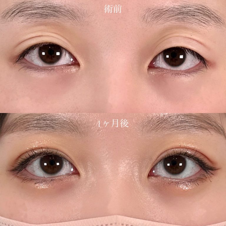 二重埋没法の症例写真05