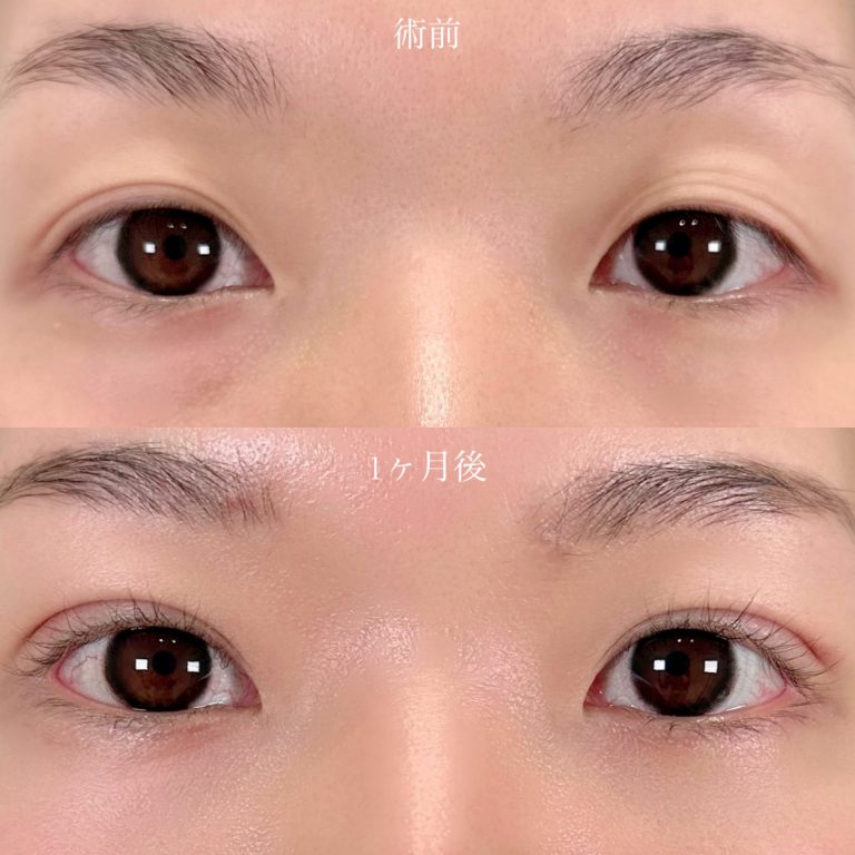 二重埋没法の症例写真06