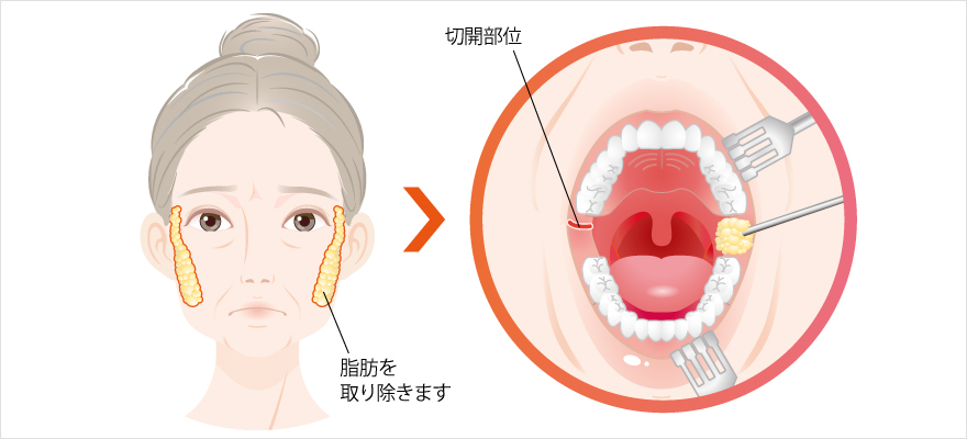 バッカルファット除去 | 小顔整形・フェイスライン | 美容整形はTCB