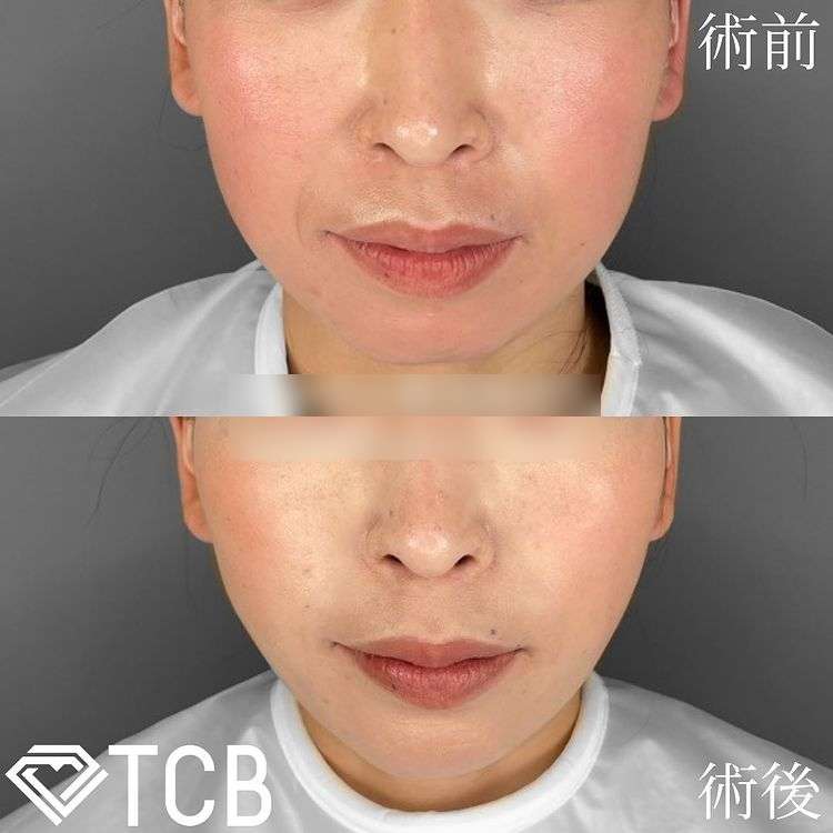 TCB小顔リフト症例写真
