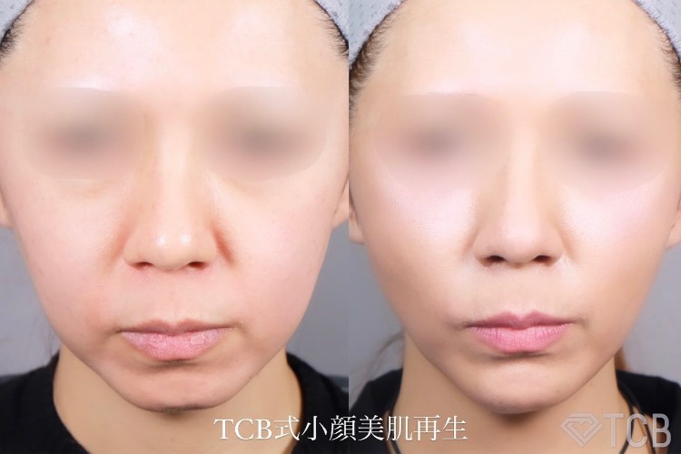 TCB式小顔美肌再生の症例写真