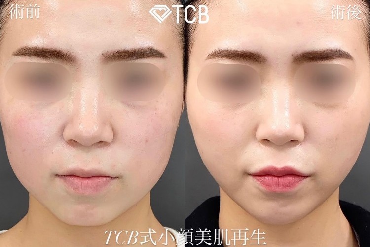 TCB式小顔美肌再生の症例写真