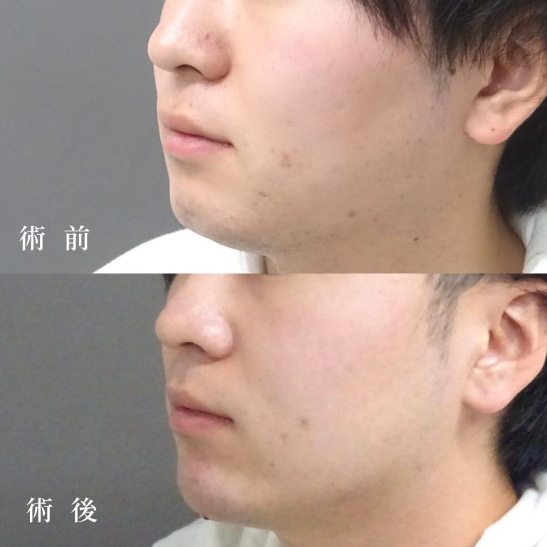 あごのヒアルロン酸注射の症例写真