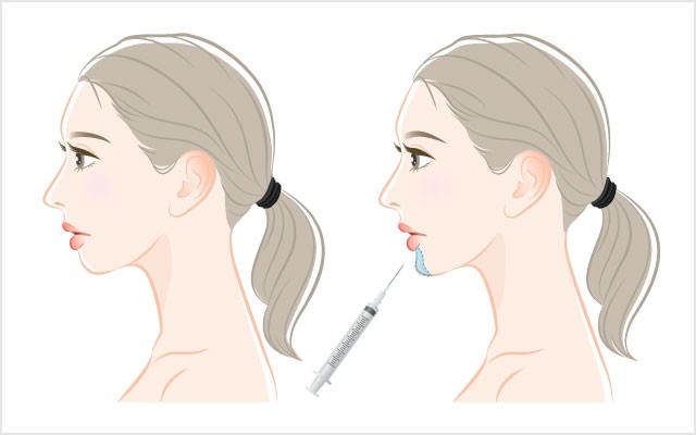 あごのヒアルロン酸注射-施術イメージ