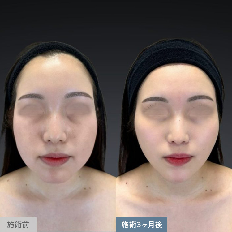 顔の脂肪吸引の症例写真01
