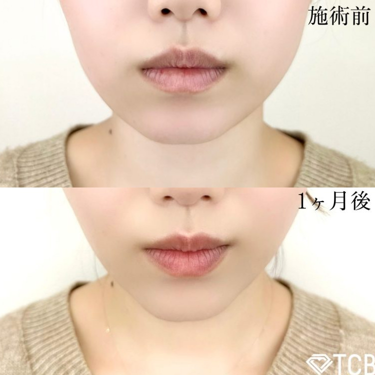 糸リフト（スレッドリフト）の症例写真